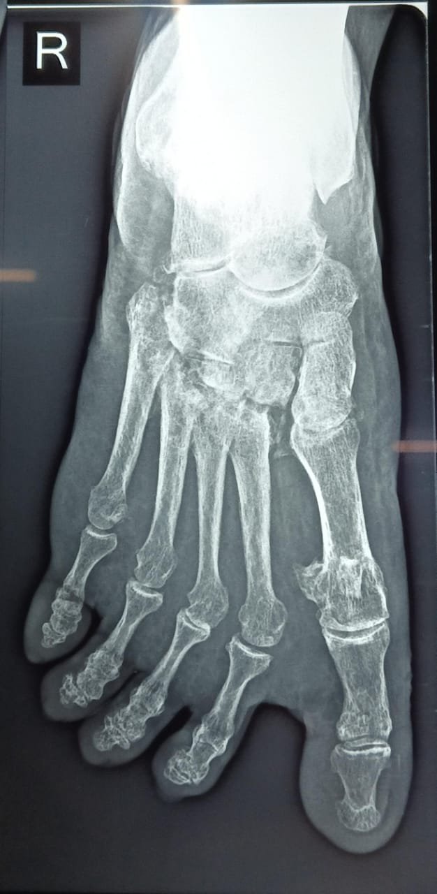 Lisfranc Injury
