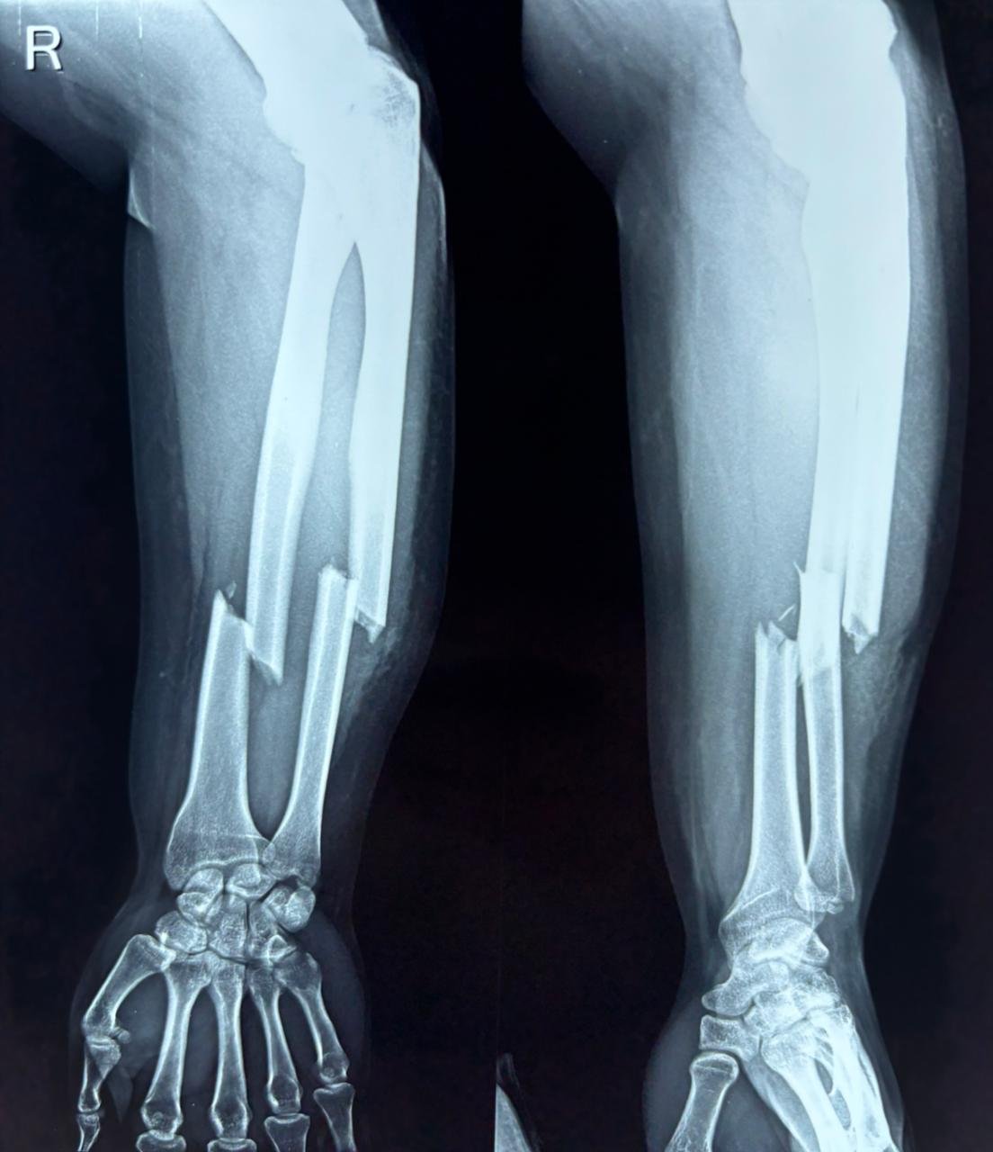 Both Bones Forearm Fracture
