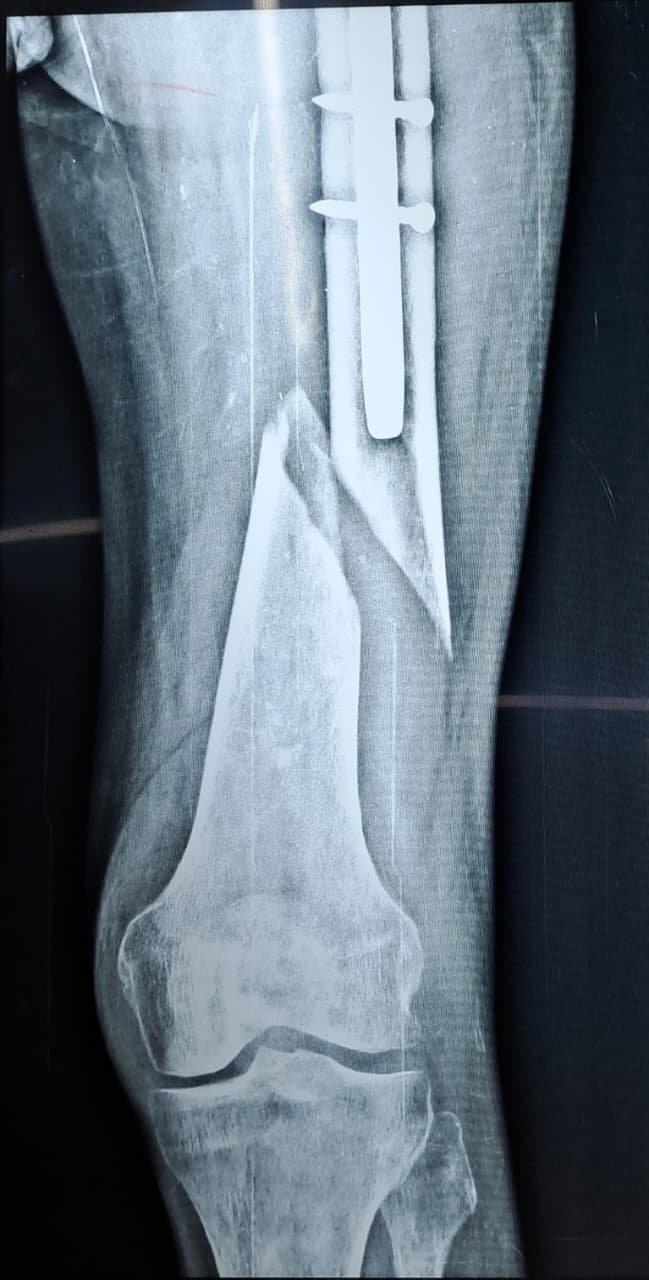 Peri-implant fracture