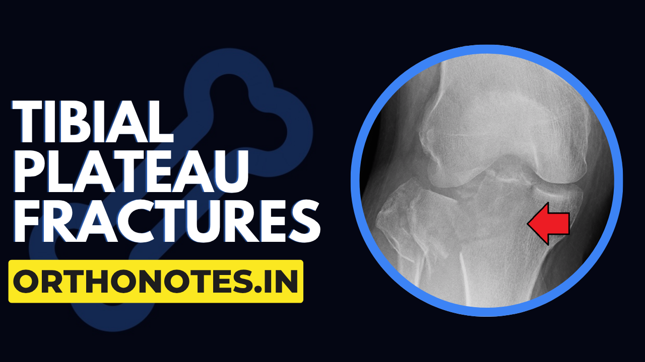 Tibial Plateau Fractures Made Easy | Classification, Management & Complications