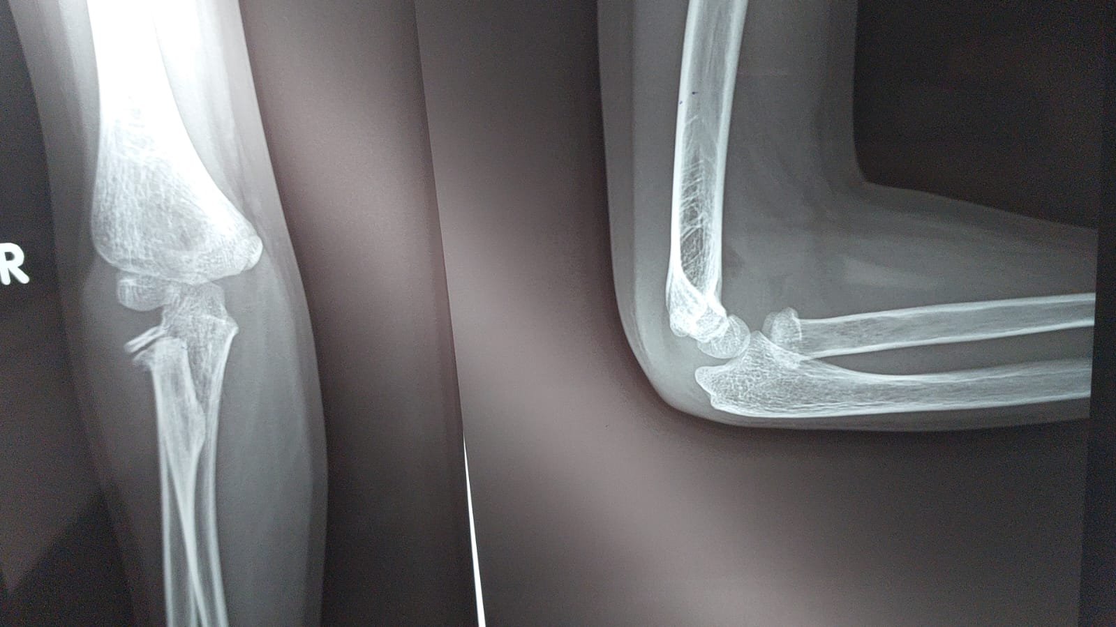 Radial Head & Neck Fractures  (Adults & Paediatrics)